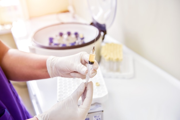 Preparación de plasma rico en plaquetas. Jeringa con plasma en manos.