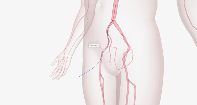 Primeiro, um cateter, um tubo fino, é inserido em um grande vaso da perna ou braço