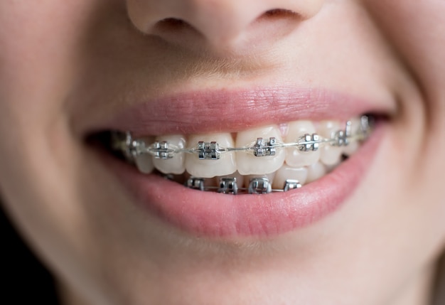 Foto primer disparo de dientes con frenillos. paciente femenino sonriente con soportes metálicos en el consultorio dental. tratamiento de ortodoncia