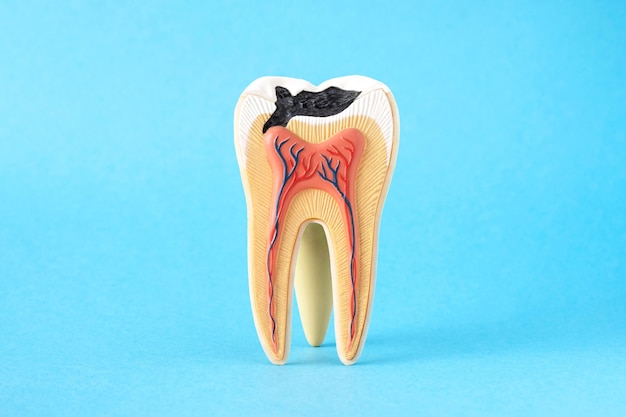 Primer modelo de estructura dental interna con primer paso de caries sobre fondo azul