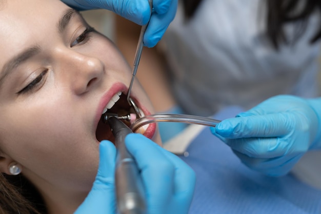 Primer plano de una boca femenina abierta. El médico dentista pone un relleno en una clienta. La enfermera ayuda a bombear la saliva.