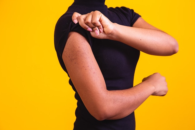 Foto primer plano en el brazo de una mujer afro con alergia.