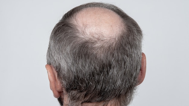 Un primer plano de una cabeza masculina medio calva, concepto de trasplante de cabello para la caída del cabello