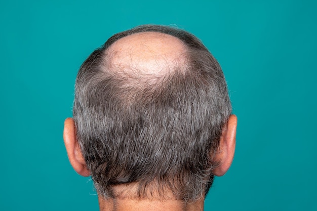 Un primer plano de una cabeza masculina medio calva, concepto de trasplante de cabello para la caída del cabello