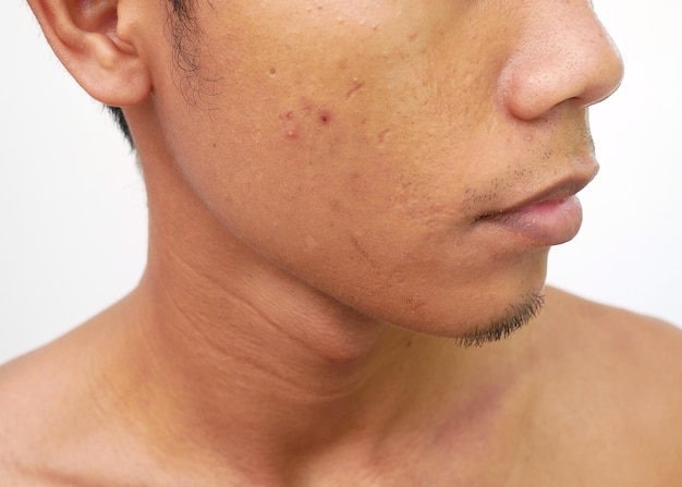 Primer plano de la cara de un hombre asiático con problemas de piel y cicatrices de acné
