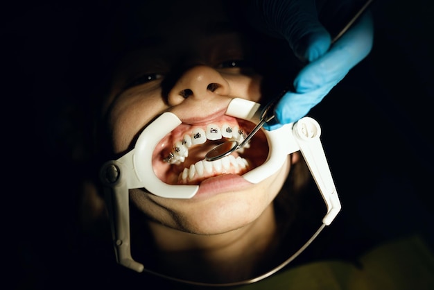 Primer plano de una chica con corchetes que recibe tratamiento con frenos dentales en la clínica