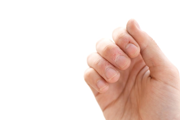 Primer plano de los dedos mordidos sobre un fondo blanco Terriblemente mordidos los dedos de una mano Estrés Nerviosismo Hábito Depresión Hasta sangre Mutilado Aislar