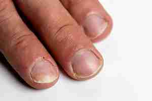 Foto primer plano de los dedos de un paciente con onicodistrofia psoriásica o enfermedad de las uñas psoriásicas