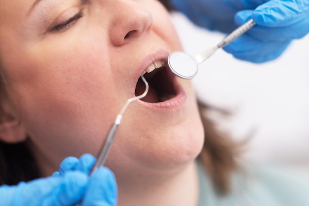 Un primer plano de un diente femenino durante un chequeo dental servicios de carillas de tratamiento de blanqueamiento dental