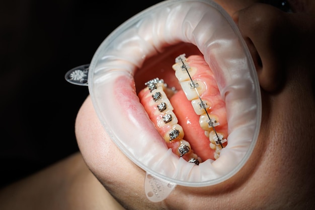 Primer plano de los dientes con aparatos ortopédicos de metal Tratamiento de ortodoncia de la mandíbula