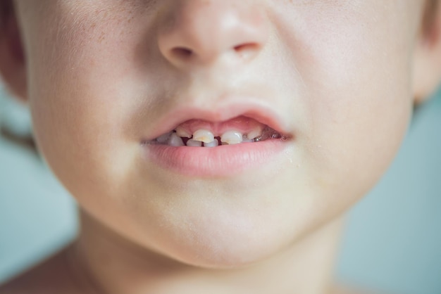 Primer plano de dientes de leche con caries.