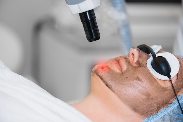 Primer plano de la exfoliación con láser de la piel del rostro. Chica haciendo procedimiento de pilling de carbono.