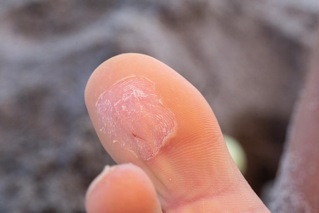Un primer plano extremo del dedo humano con una ampolla curativa