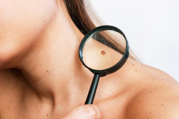 Foto primer plano de un gran lunar en el cuello de una mujer joven magnificado con una lupa