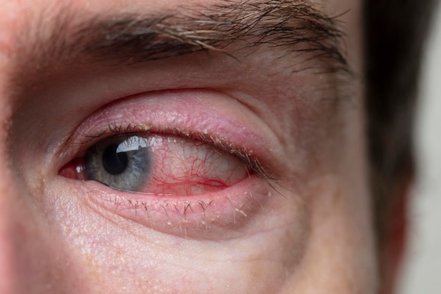 Primer plano de una grave condición de conjuntivitis blefaritis ocular inyectada en sangre