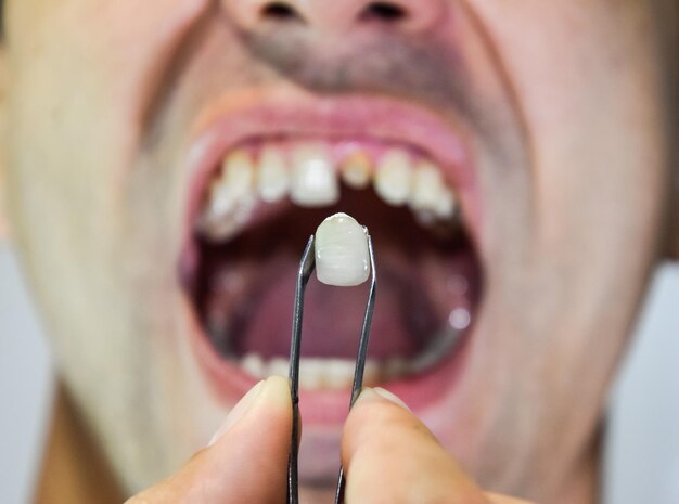 Foto primer plano de un hombre con dientes