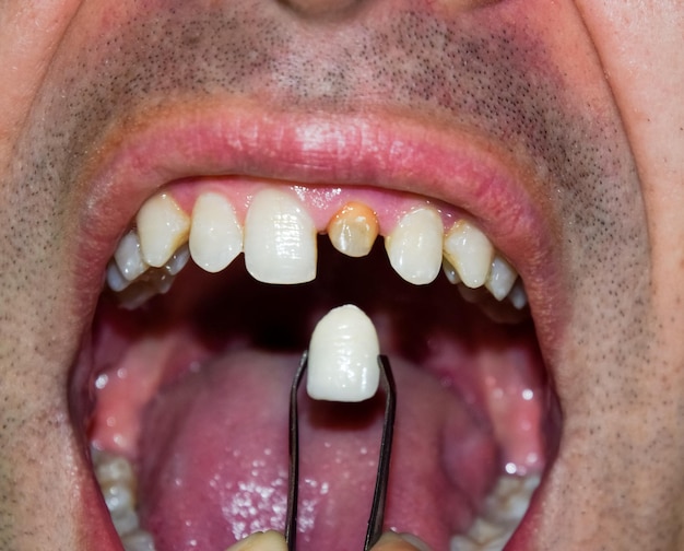 Foto primer plano de un hombre sosteniendo dientes