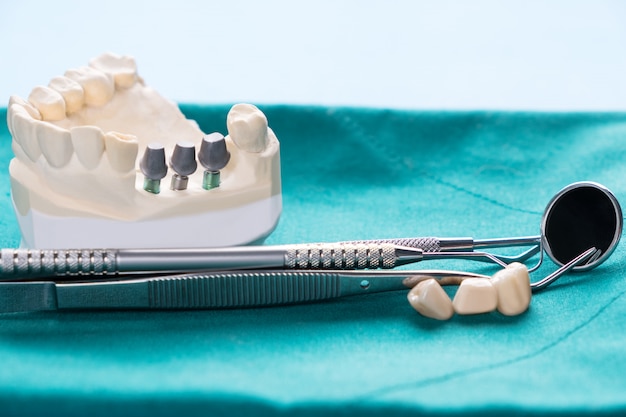 Primer plano Implante modelo diente soporte fijación puente implante y corona.