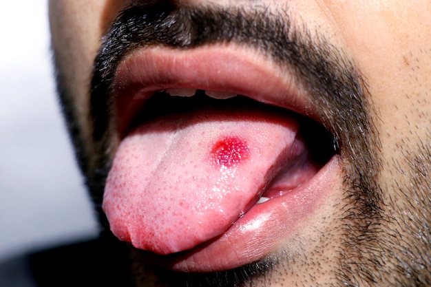Primer plano de una lengua enferma en la que brilla una mancha roja. Ardor y malestar en la lengua.