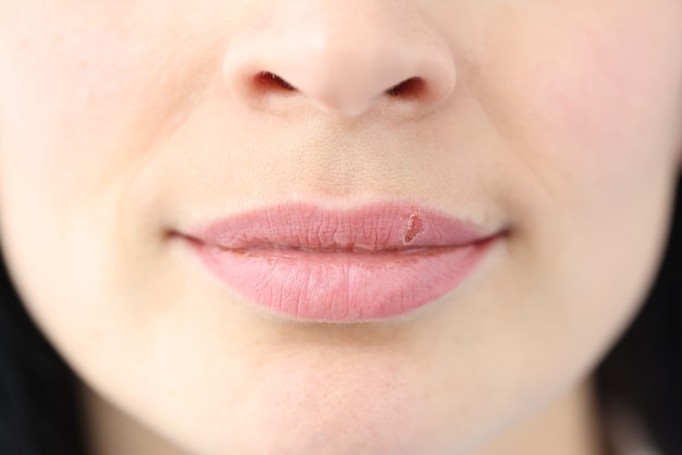 Primer plano de llagas de herpes en los labios de una mujer joven. Tratamiento y diagnóstico dermatológico.