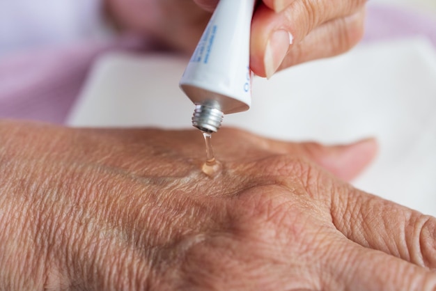 Primer plano de la mano de una anciana aplicando una crema para problemas dermatológicos