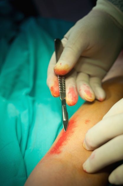 Primer plano de una mano con un bisturí para cortar la piel de un paciente