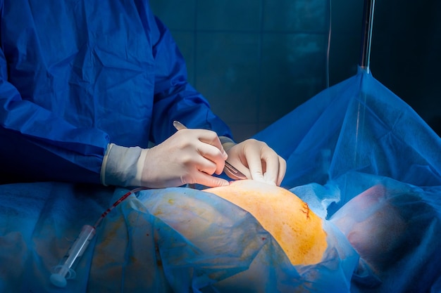 Primer plano de la mano del médico mientras el cirujano y el asistente realizan una cirugía en el equipo médico utilizando varios instrumentos quirúrgicos en el quirófano