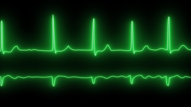 Primer plano de un monitor médico con líneas verdes de ECG que muestran fibrilación auricular