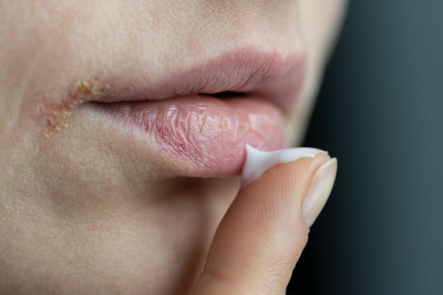 Primer plano de una mujer aplicando bálsamo labial con el dedo para evitar la sequedad y el agrietamiento en la estación fría