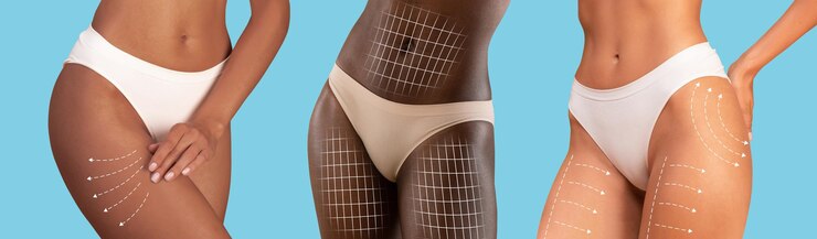 Primer plano de mujeres jóvenes diversas en bikini con cuerpo delgado de piel perfecta con líneas para moldear el cuerpo o masaje de drenaje