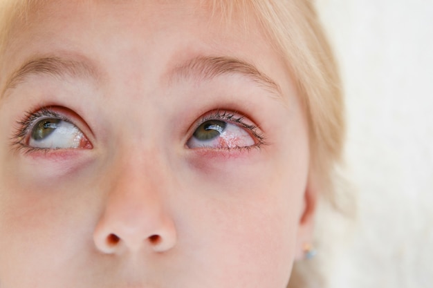 Primer plano de una niña con conjuntivitis.