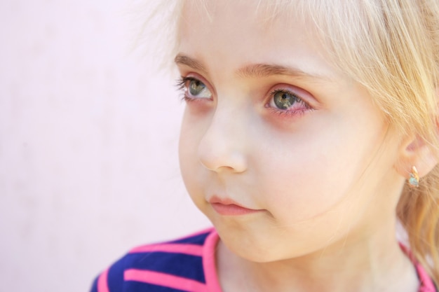 Primer plano de una niña con conjuntivitis.