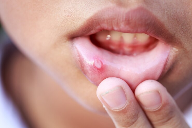 Primer plano Niños con aphtha en el labio