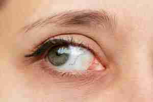Foto primer plano del ojo femenino con capilares rojos inflamados y dilatados queratitis síndrome del ojo seco