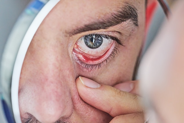 Foto primer plano del ojo humano que está rojo e irritado. síntoma de ojos secos.