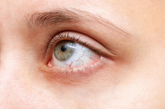 Primer plano del ojo de la mujer con capilares rojos inflamados y dilatados, síndrome del ojo seco, trauma, uveítis