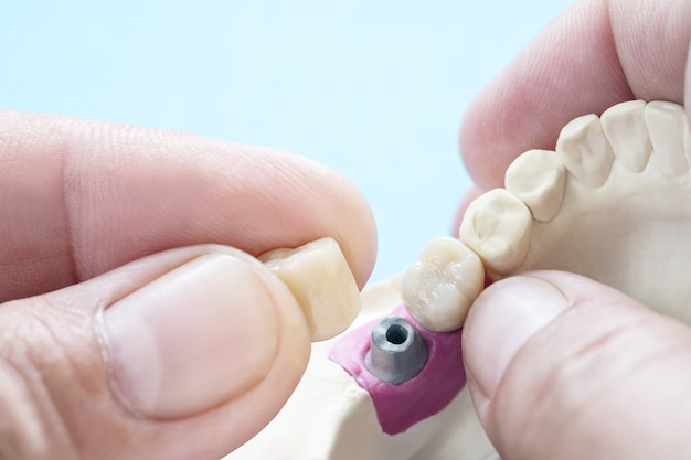 Primer plano / prótesis de implante o prótesis / coronas y puentes dentales equipos de odontología de implantes y restauración de modelos express fix.