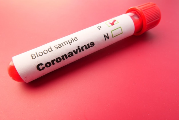 Primer plano de la prueba de tubo de sangre etiqueta del virus corona