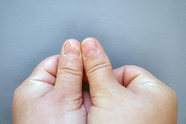 Primer plano del pulgar con hongos sobre un fondo gris