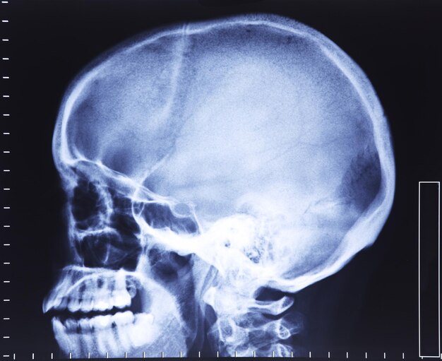 Primer plano de rayos X del cráneo humano