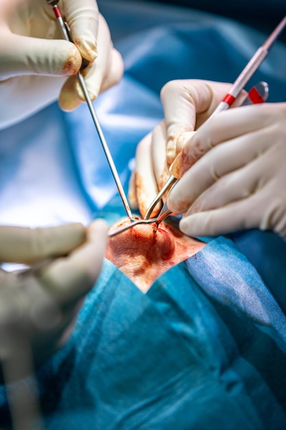 Primer plano de rinoplastia de cirugía de nariz Las manos de las herramientas de trabajo del cirujano en guantes blancos