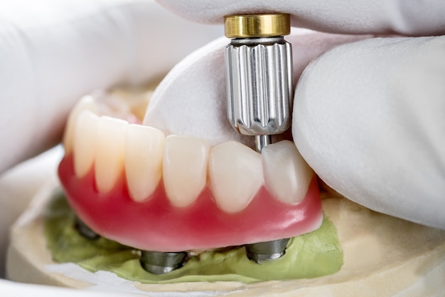 Foto primeros / implantes dentales soportados sobredentadura sobre fondo azul / tornillo retenido / restauraciones de implantes.