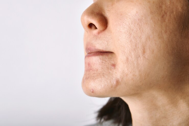 Problema de pele com cicatriz de doenças de acne e rosto oleoso e oleoso