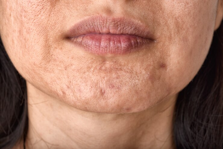 Problema de pele e cicatriz de acne do envelhecimento com espinhas