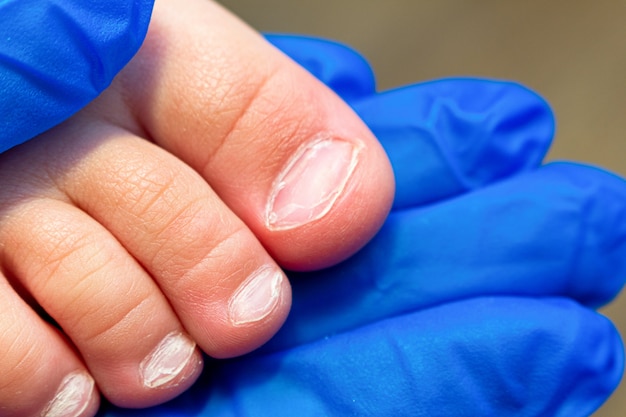 Problema de unhas nos pés das crianças na mão com luvas de medicina