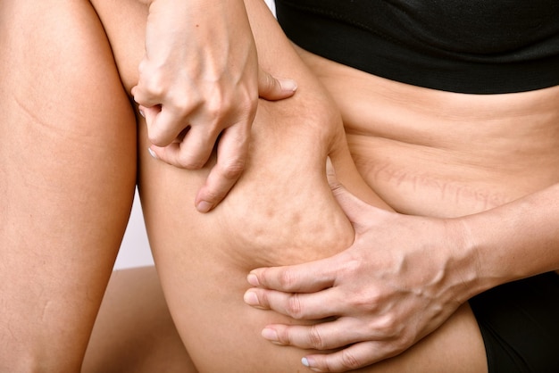 Problema de marca de celulitis en la pierna, mujer gorda con exceso de pellizco en la piel del muslo, prueba corporal con sobrepeso.