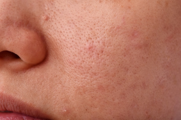 Problema de la piel con enfermedades del acné, cerca de la cara de la mujer con la boca del labio seco, cicatriz y rostro grasiento grasiento, concepto de belleza.