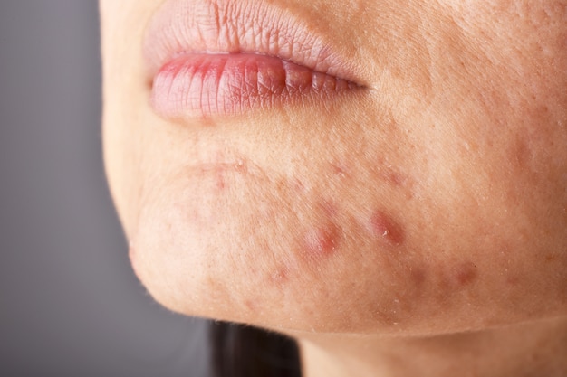 Foto problema de la piel con enfermedades del acné, rostro de mujer de cerca con espinillas blancas en el mentón, ruptura de la menstruación, cicatriz y cara grasosa.