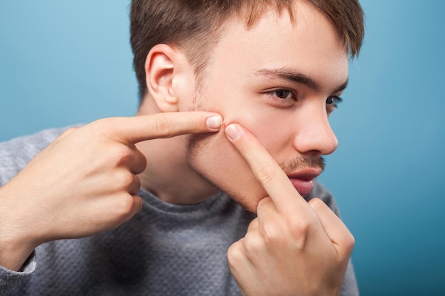 Problemas de higiene e pele Retrato de jovem morena com cerdas e bigode espremendo espinha no rosto sofrendo acne conceito de cuidados com a pele masculino tiro de estúdio interior isolado em fundo azul