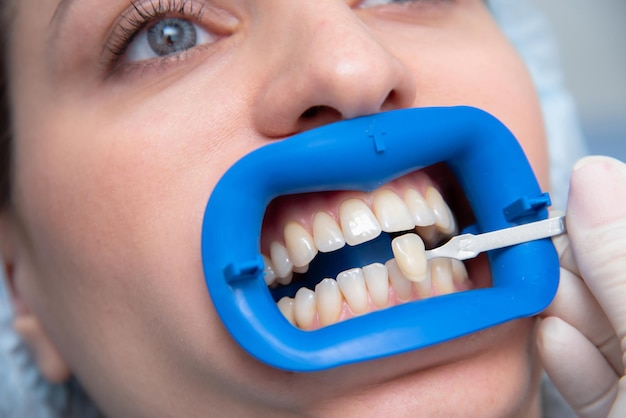 Procedimiento para comparar los tonos de color de los dientes mediante pruebas antes del blanqueamiento